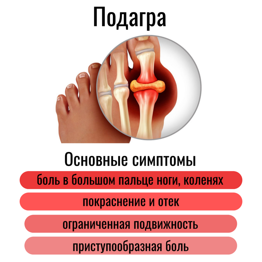 podagra