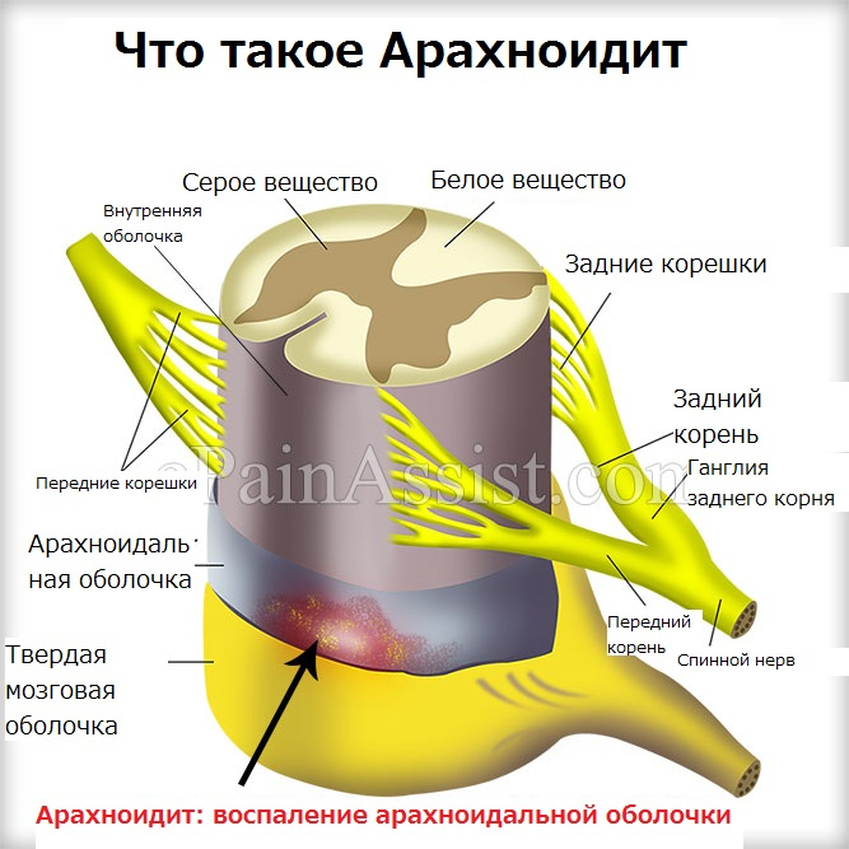 arahnoidit 1