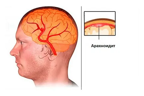 arahnoidit 2