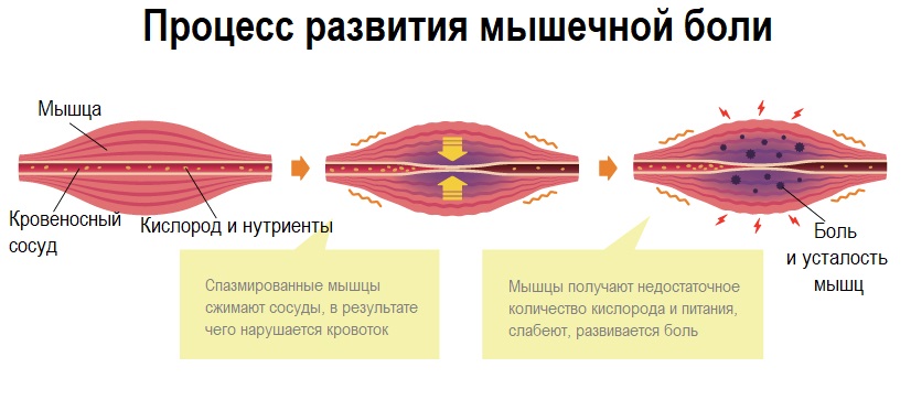 Механизм развития миалгии