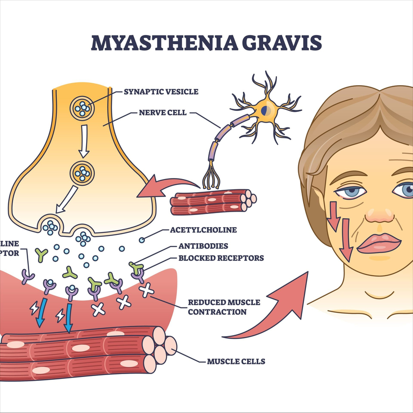 miastenia 1