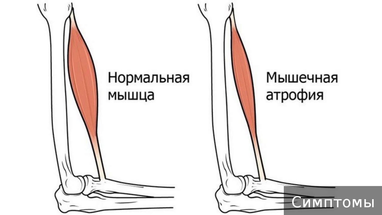 miopatia1 1