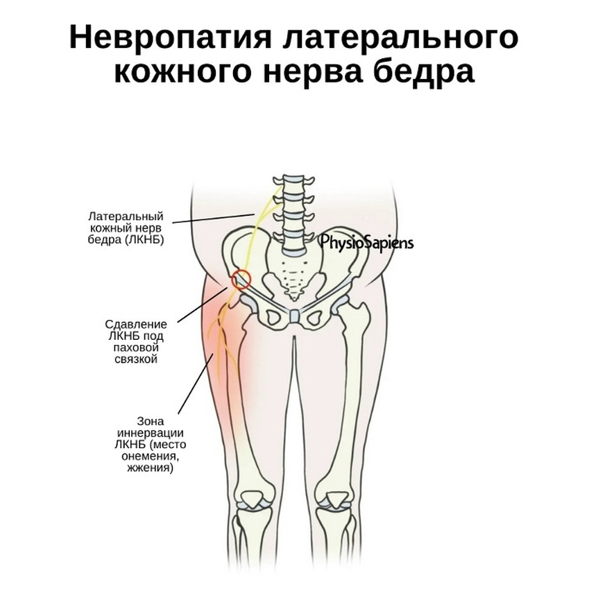 nevralgia naruznogo koznogo nerva bedra 1