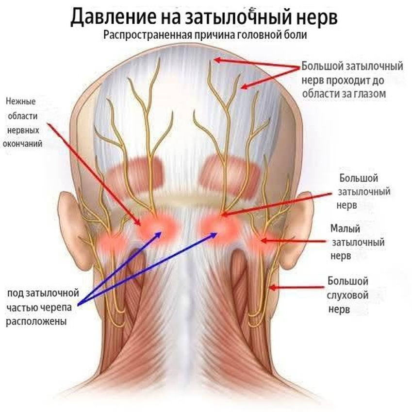 nevralgia zatylocnyh nervov 1