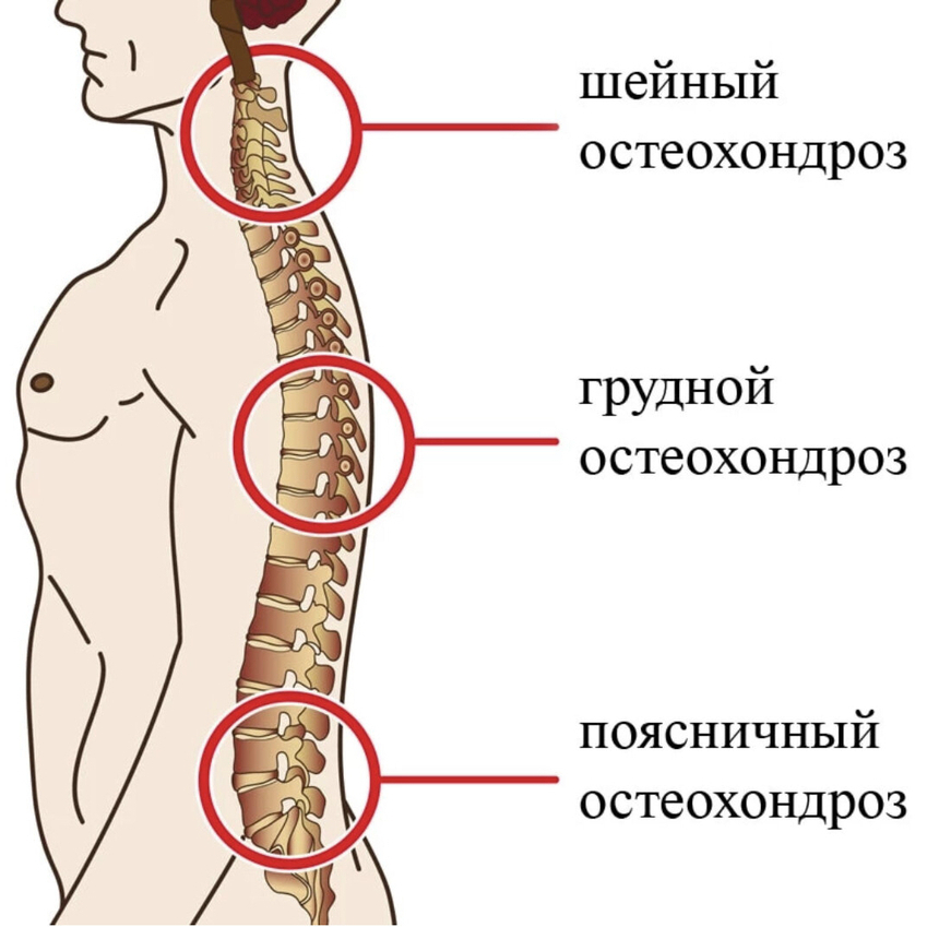 osteohondrozy 1