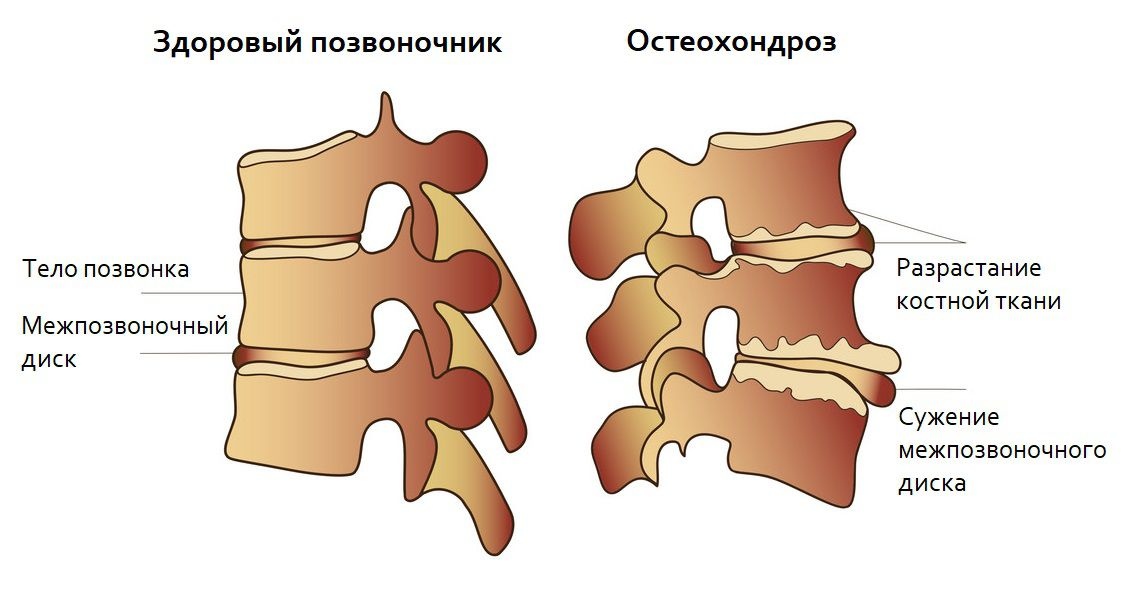 osteohondrozy 2