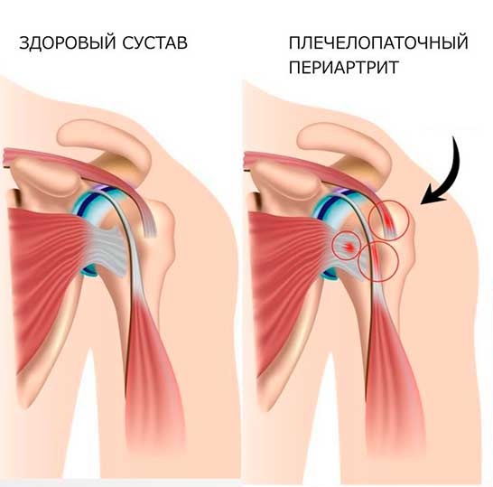 plecelopatocnyj periartrit