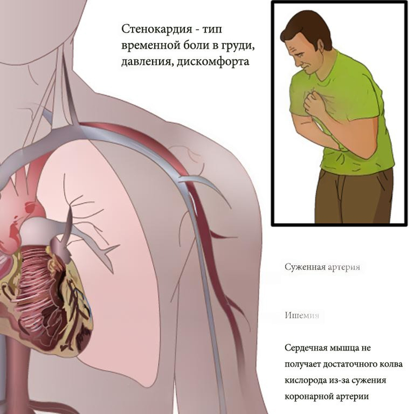 STENOKARDIA 1