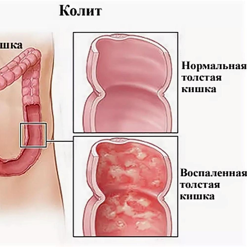 KOLIT