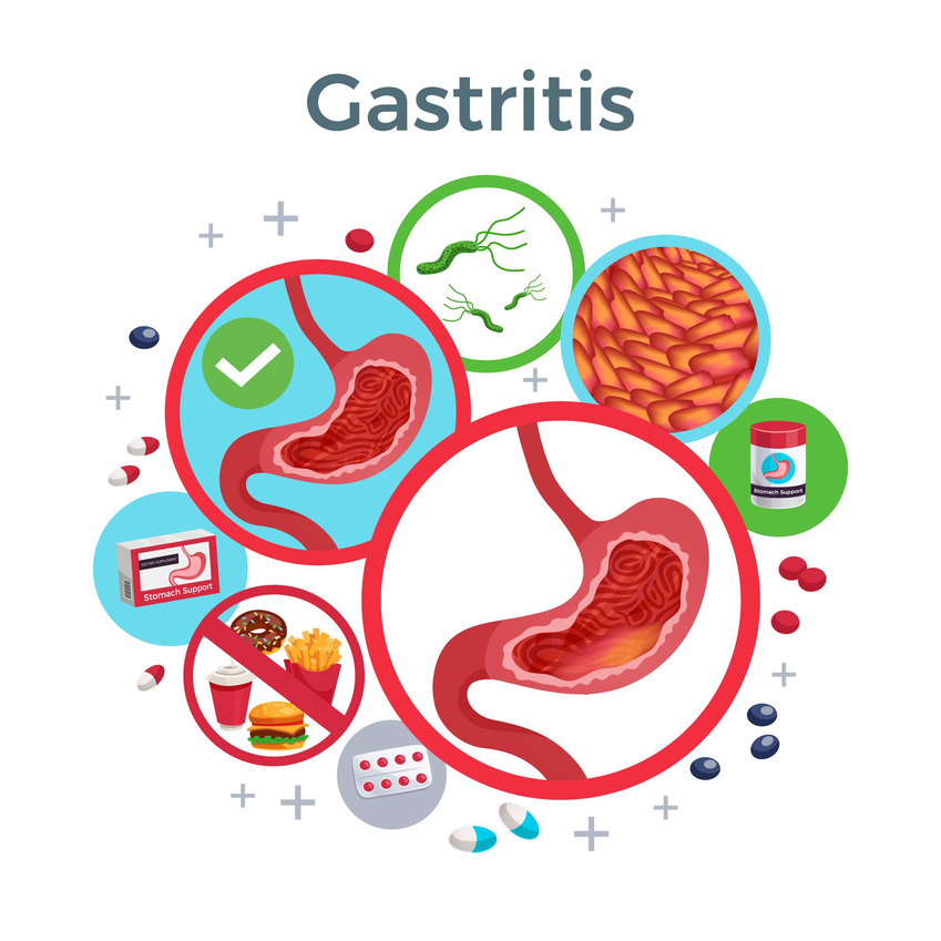 hroniceskij gastrit