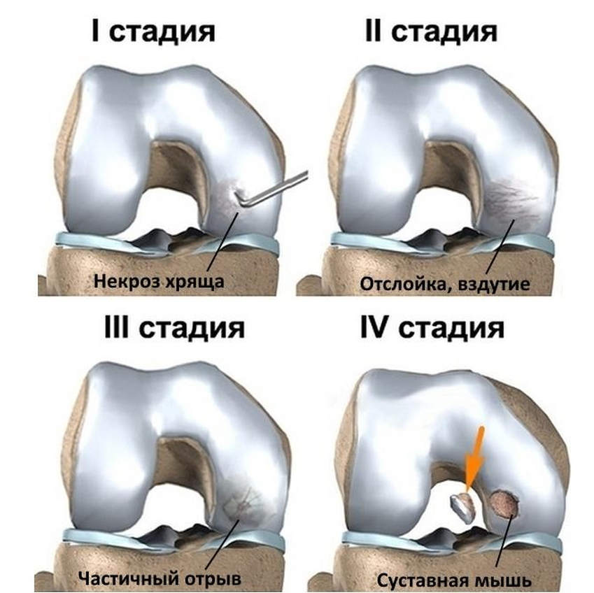 osteohondropatia1