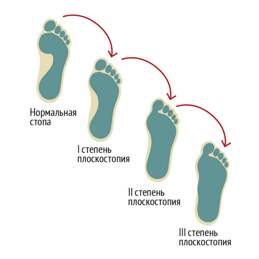 ploskostopie