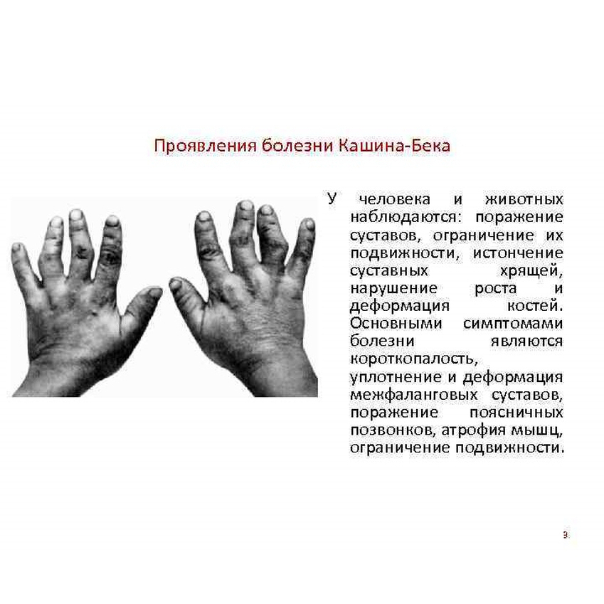 urovskaa bolezn